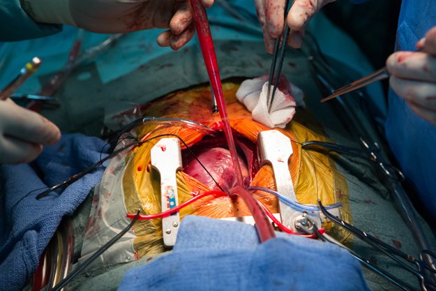 It’s not every day we get to see a human heart laid bare. Here doctors prepare for closure after repairing an atrial septal defect. 