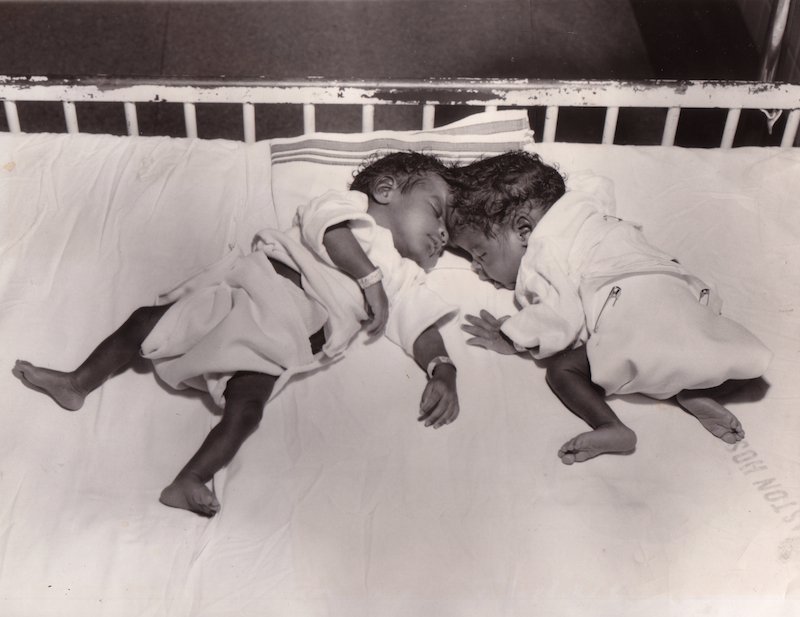 A Memphis Medical Miracle The Miller Conjoined Twins Memphis